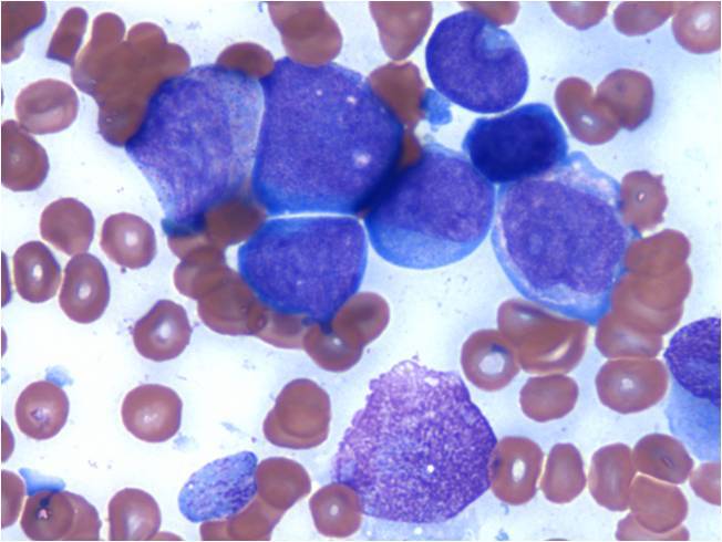 Bone marrow aspirate smear shows a cluster of blasts (Gimesa, x1000).